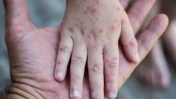 Kasus Campak Melonjak di Awal 2026, Pakar UGM Ingatkan Bahaya Komplikasi Serius