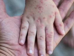 Kasus Campak Melonjak di Awal 2026, Pakar UGM Ingatkan Bahaya Komplikasi Serius